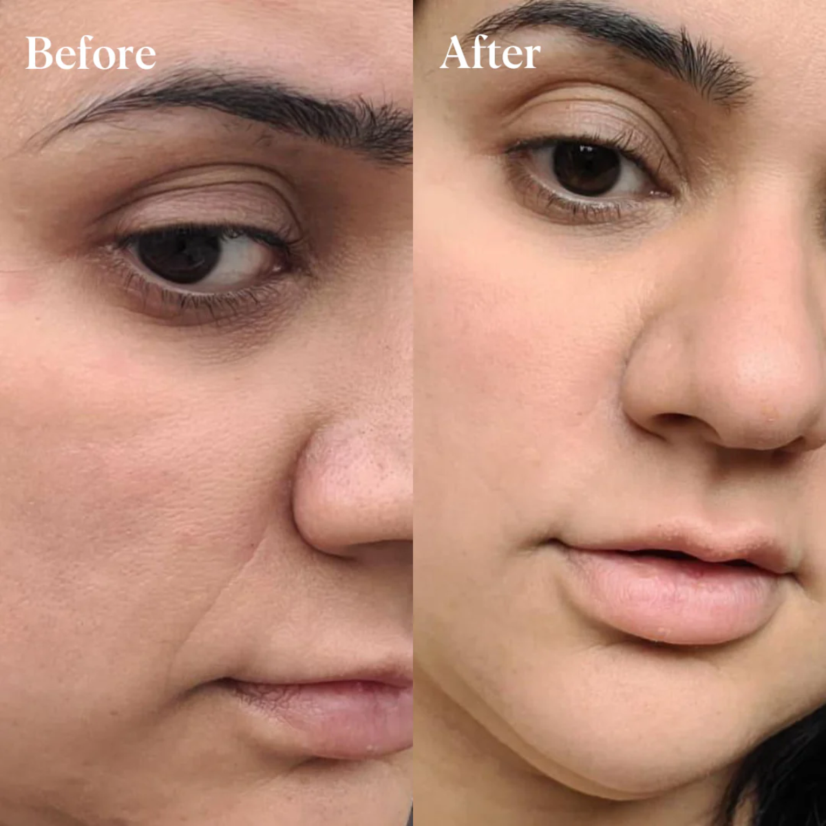 DeepCare+™ Microfusion Repair Patches